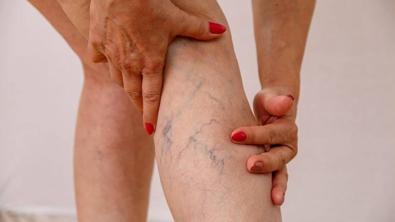 Les manifestations d'insuffisance veineuse toucheraient au moins 18 millions de personnes en France.