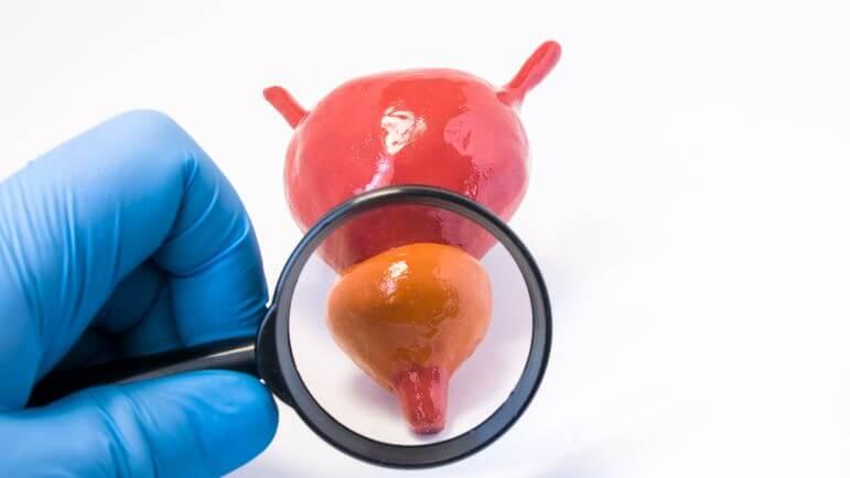 L’hypertrophie bénigne de la prostate est la tumeur bénigne la plus fréquente chez l’homme.