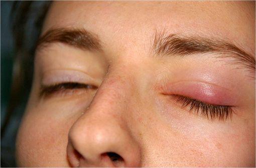 Début d'infection du type chalazion (illustration @jd, sur Wikimedia).